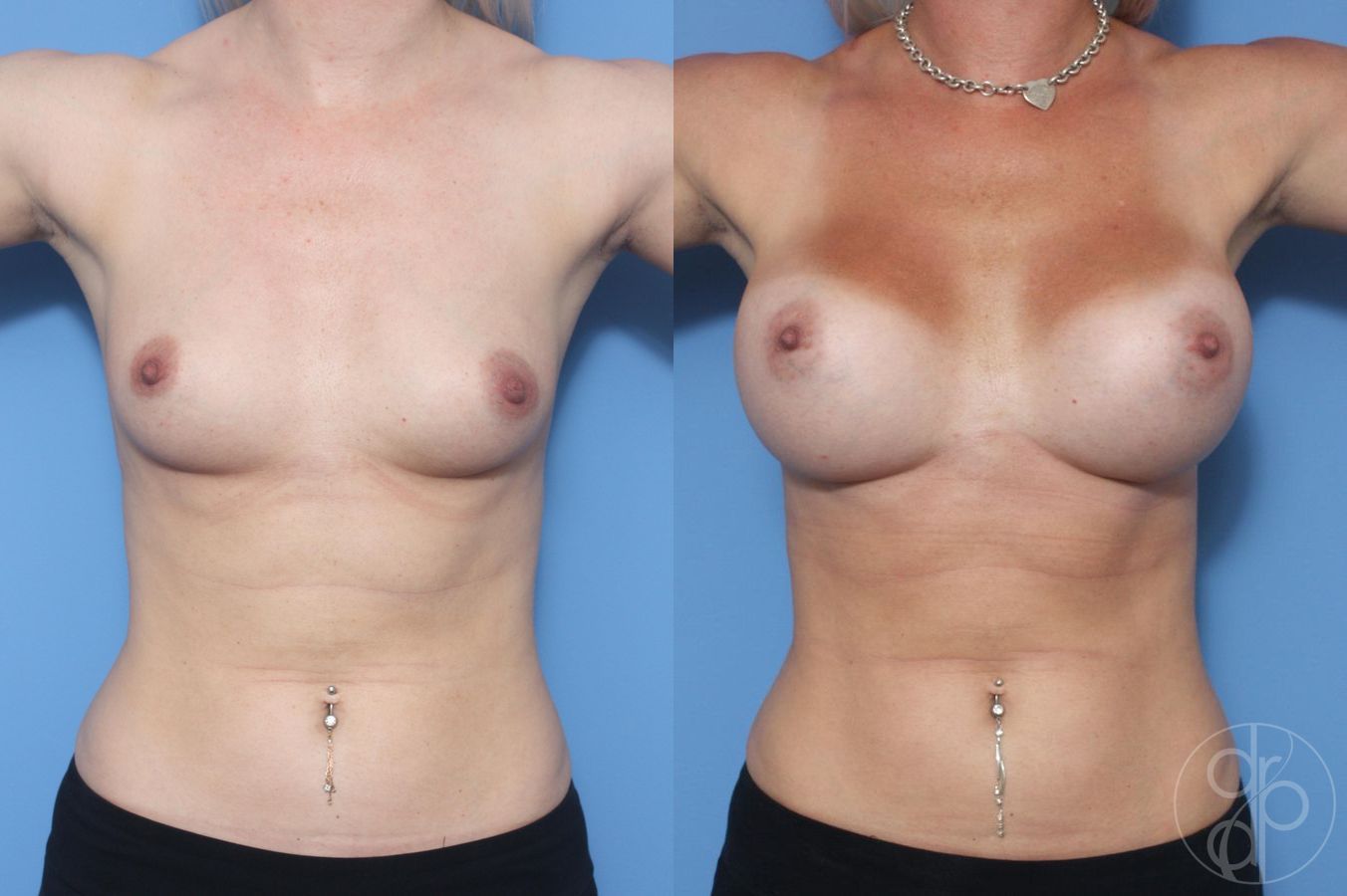 Before and after Breast Augmentation case 29616 - Angle 2
