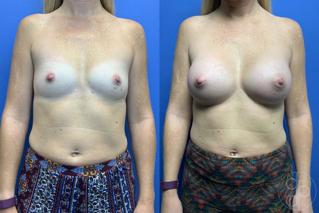 Before and after Breast Augmentation case 29960
