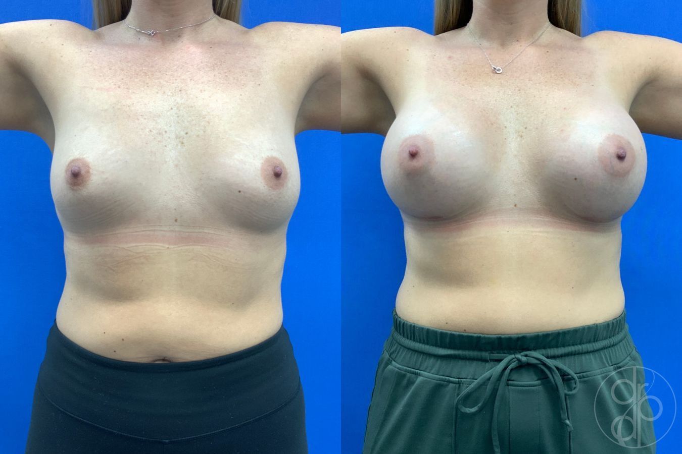 Before and after Breast Augmentation case 43197 - Angle 2