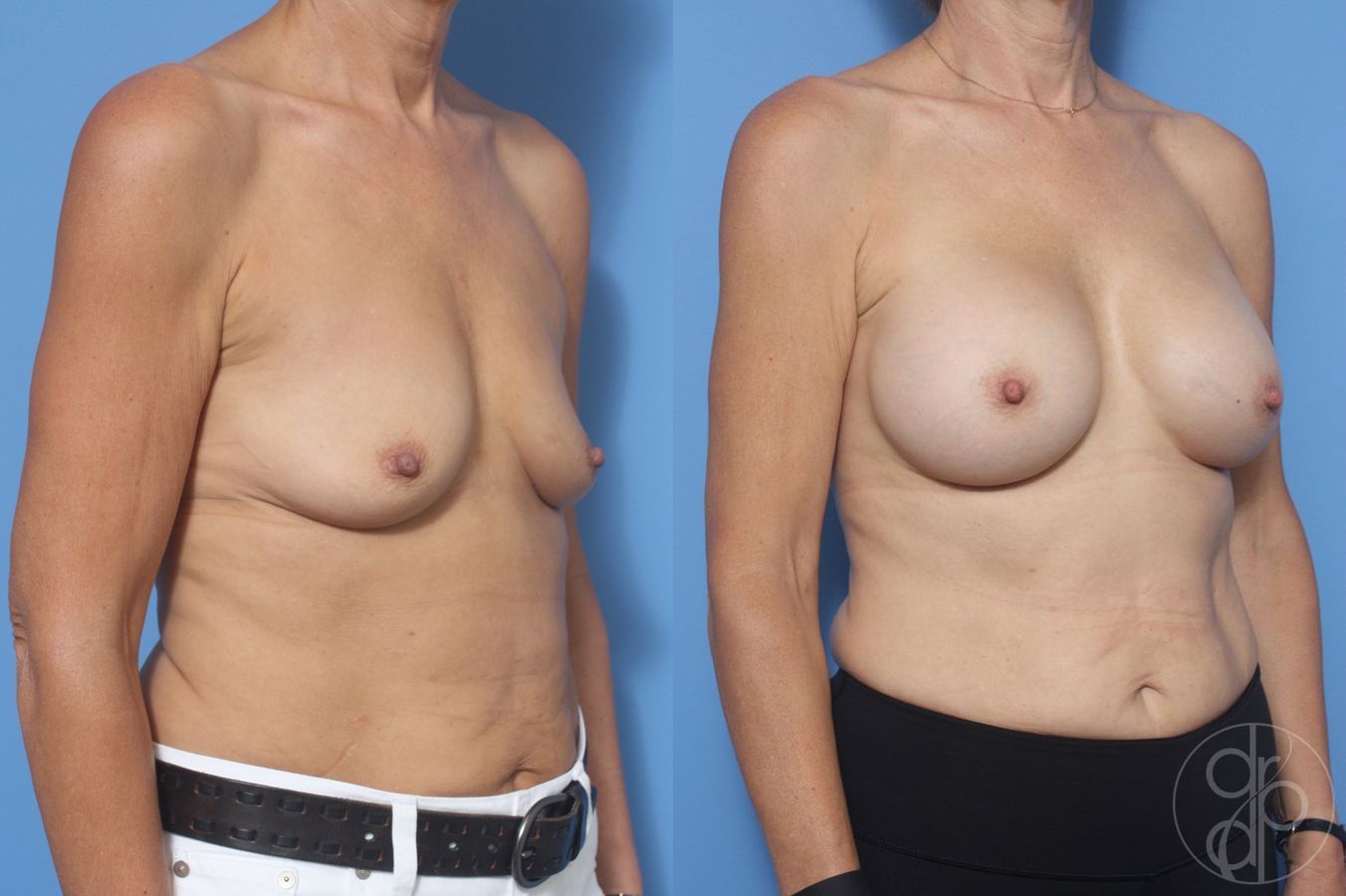 Before and after Breast Augmentation case 29955 - Angle 2