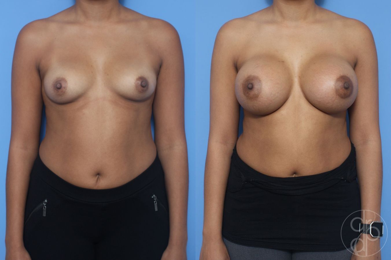 Before and after procedure result