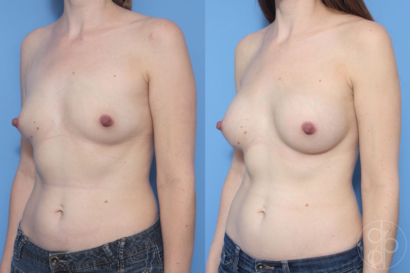 Before and after Breast Augmentation case 29950 - Angle 3