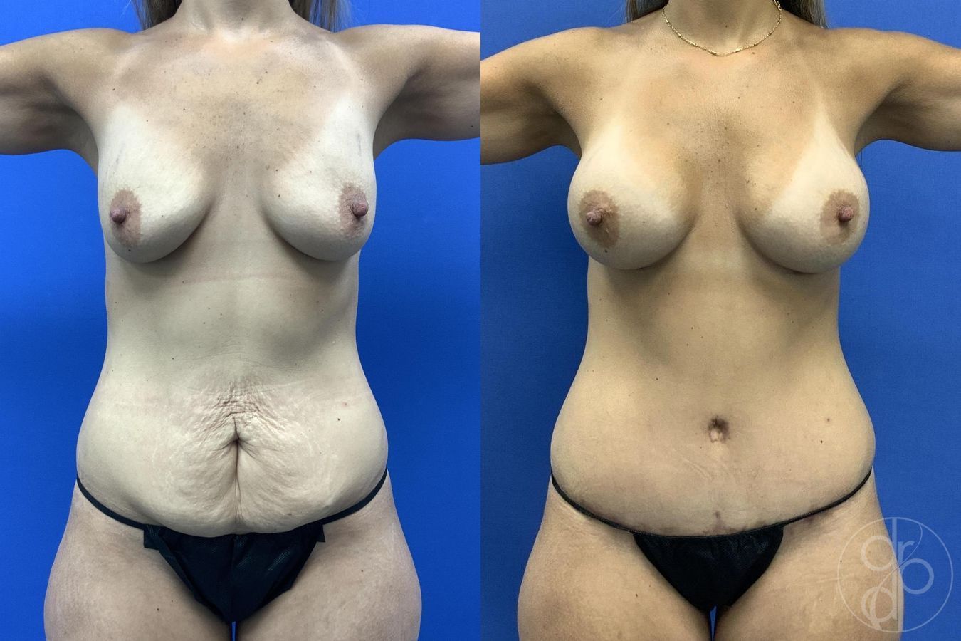 Before and after Breast Augmentation case 29723 - Angle 2