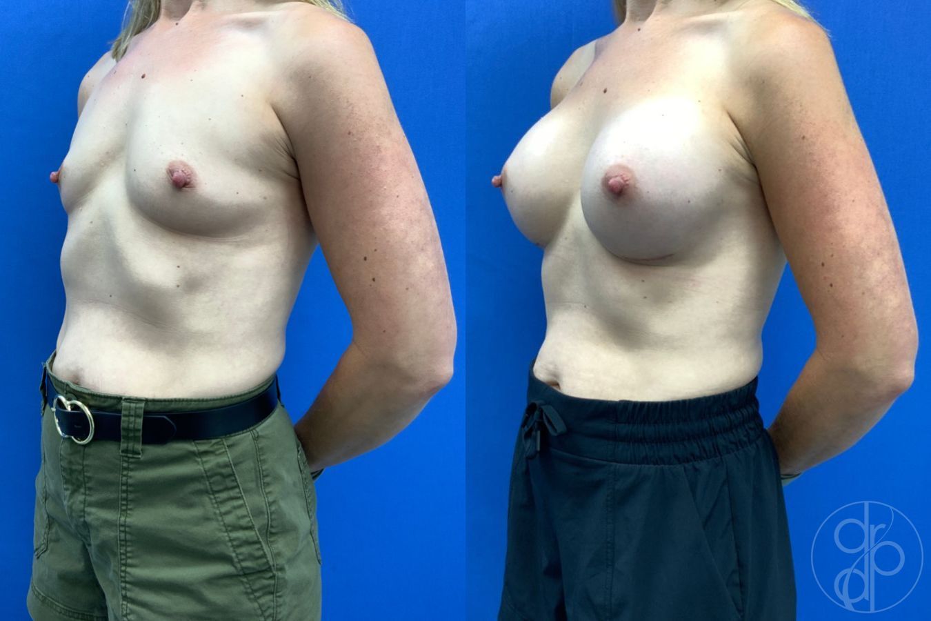 Before and after Breast Augmentation case 49410 - Angle 4