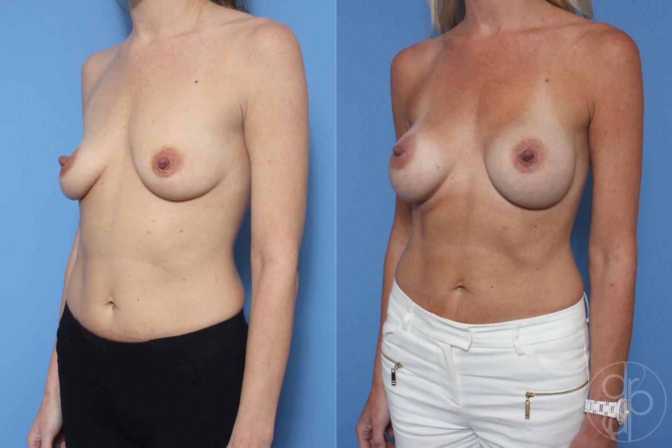 Before and after Breast Augmentation case 29938 - Angle 3