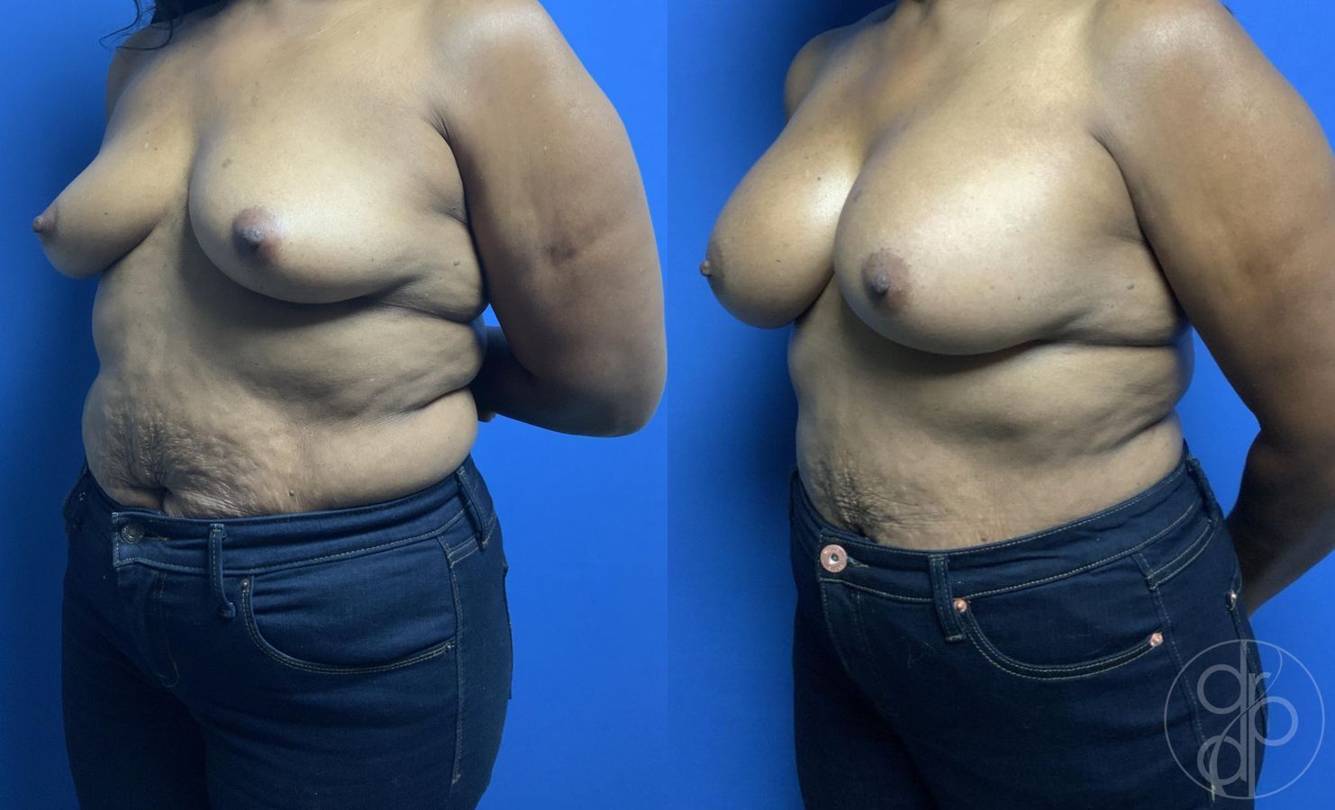 Before and after Breast Augmentation case 29786 - Angle 3