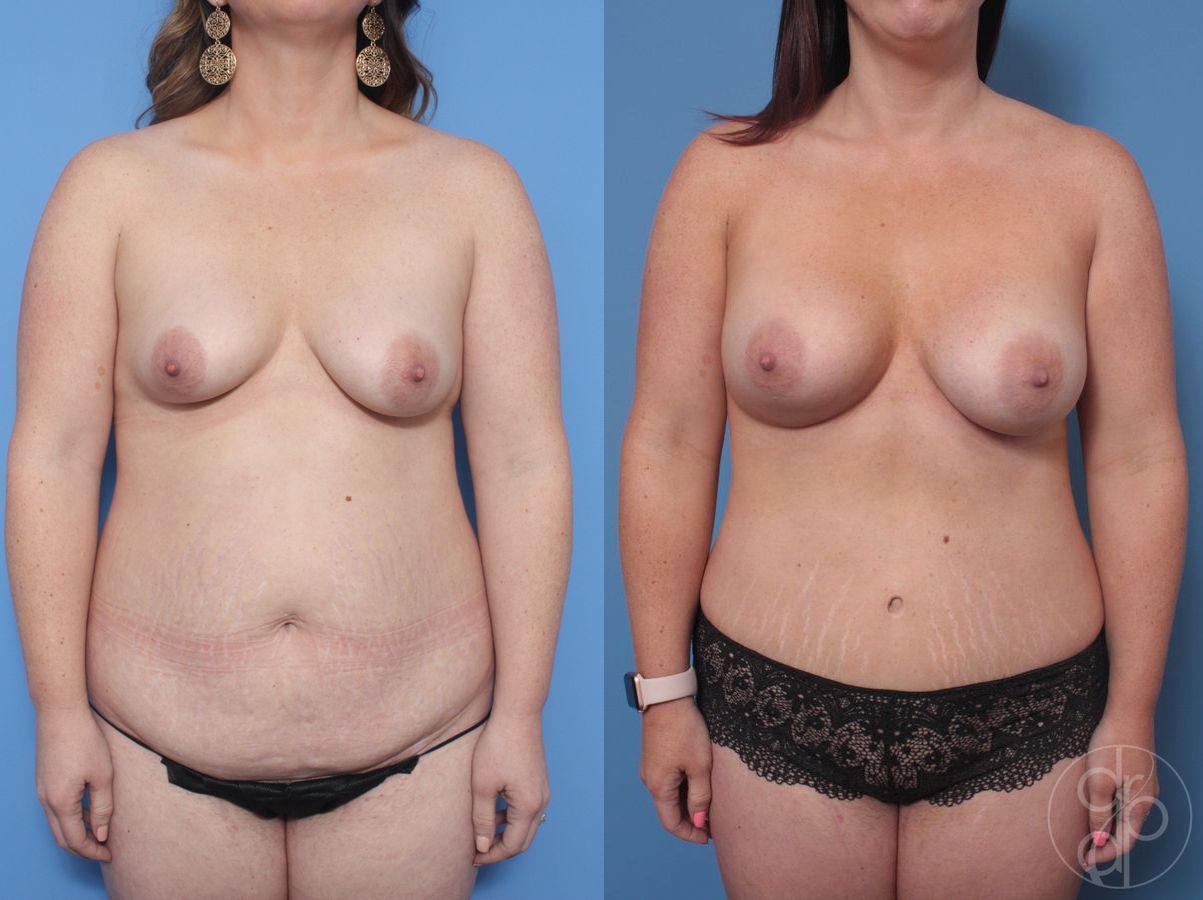 Before and after Breast Augmentation case 29710