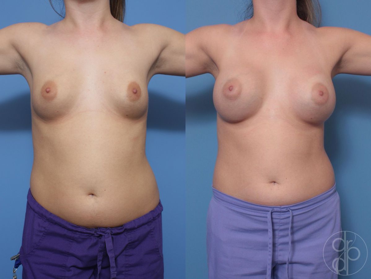 Before and after Breast Augmentation case 29821 - Angle 2