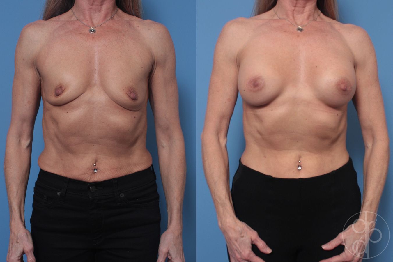 Before and after Breast Augmentation case 29925