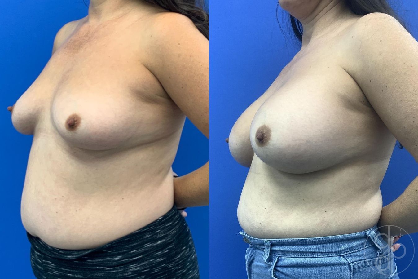 Before and after Breast Augmentation case 29611 - Angle 3