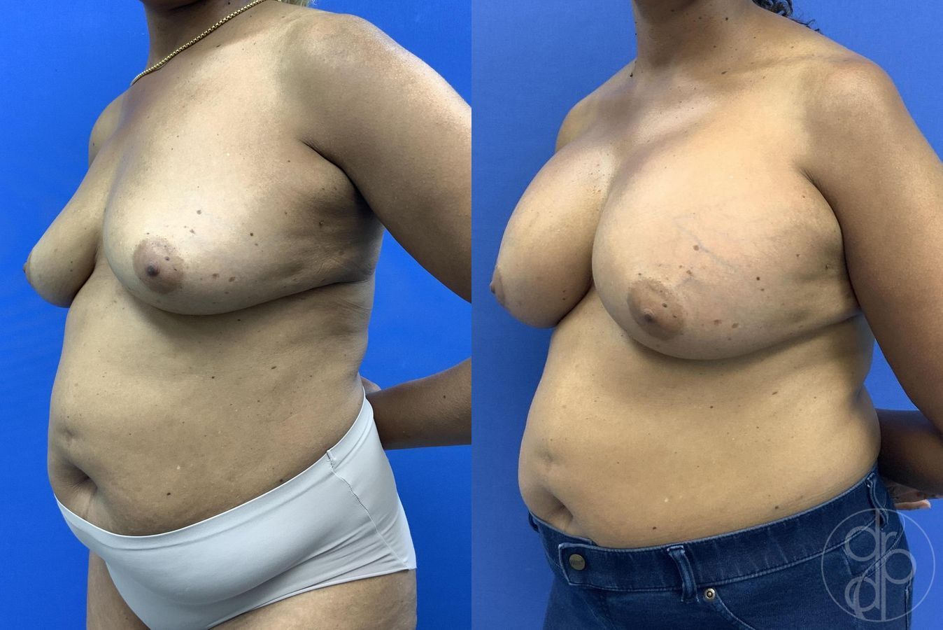 Before and after Breast Augmentation case 30026 - Angle 4