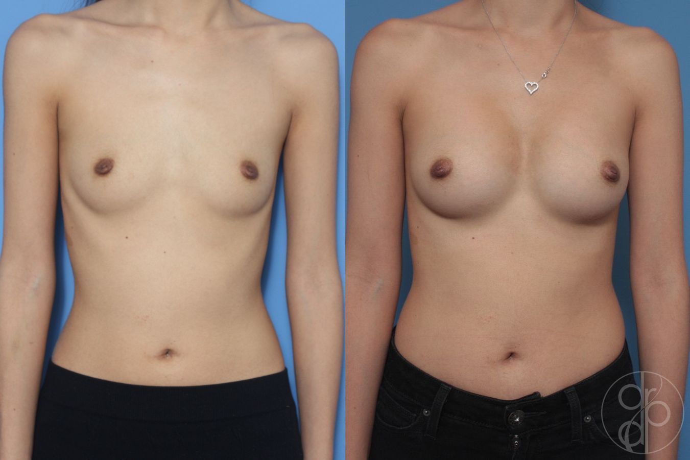 Before and after Breast Augmentation case 29833