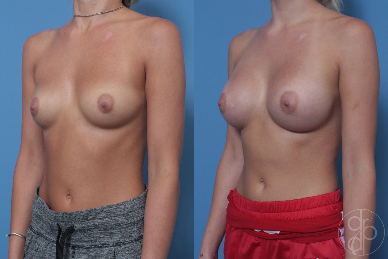 Before and after Breast Augmentation case 29939 - Angle 3