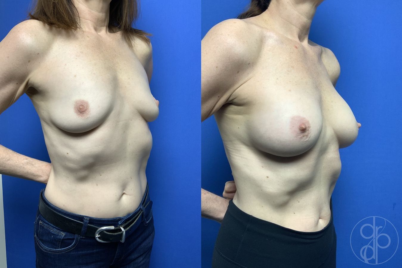 Breast Augmentation - Thumbnail 2