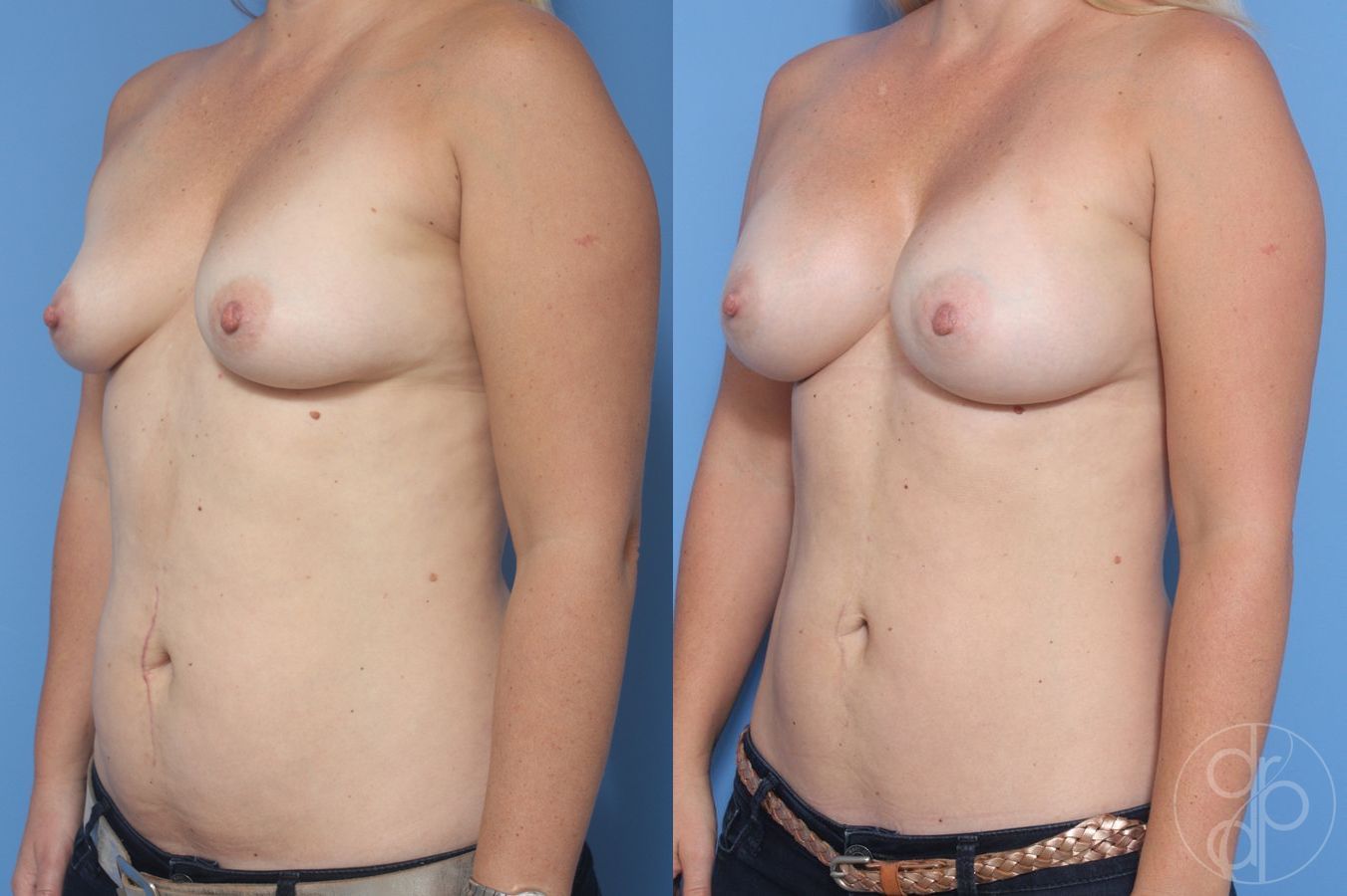 Before and after Breast Augmentation case 29946 - Angle 3
