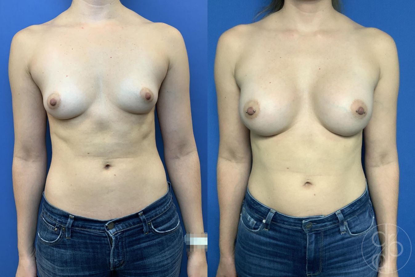 Breast Augmentation - Case 380