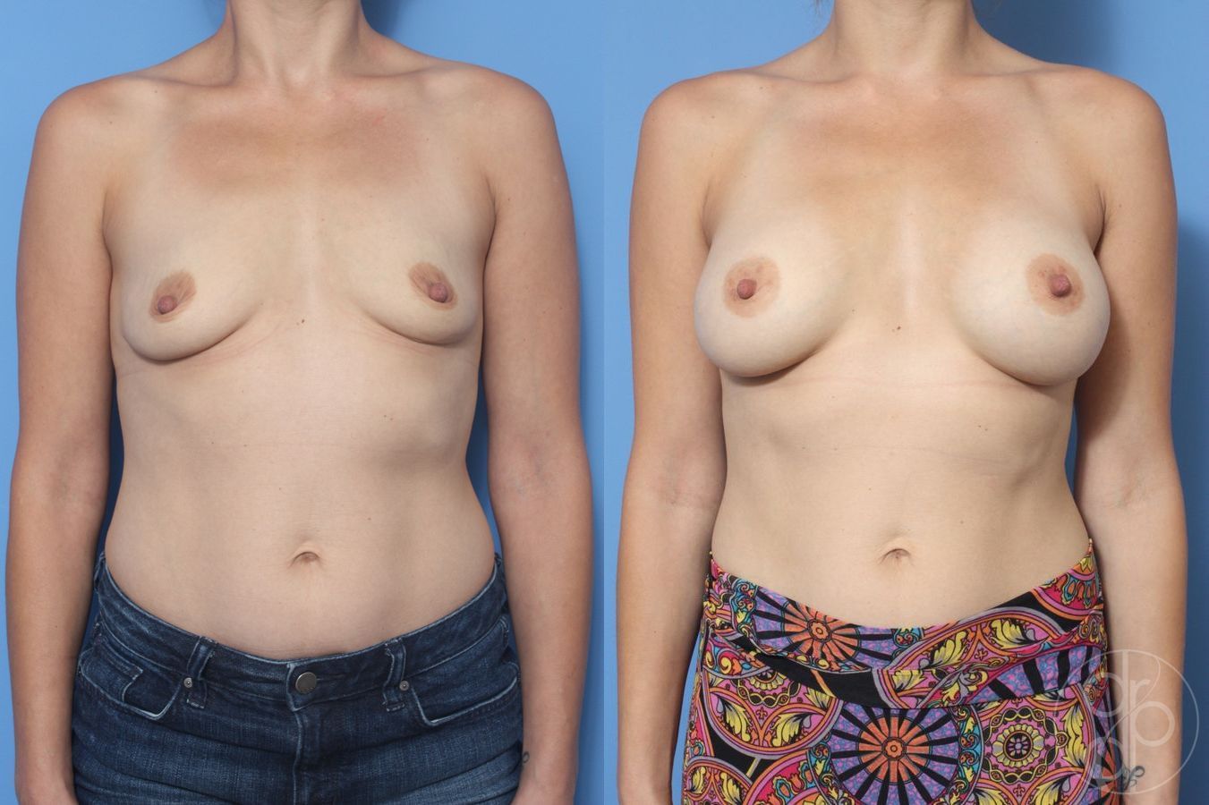 Before and after Breast Augmentation case 29926