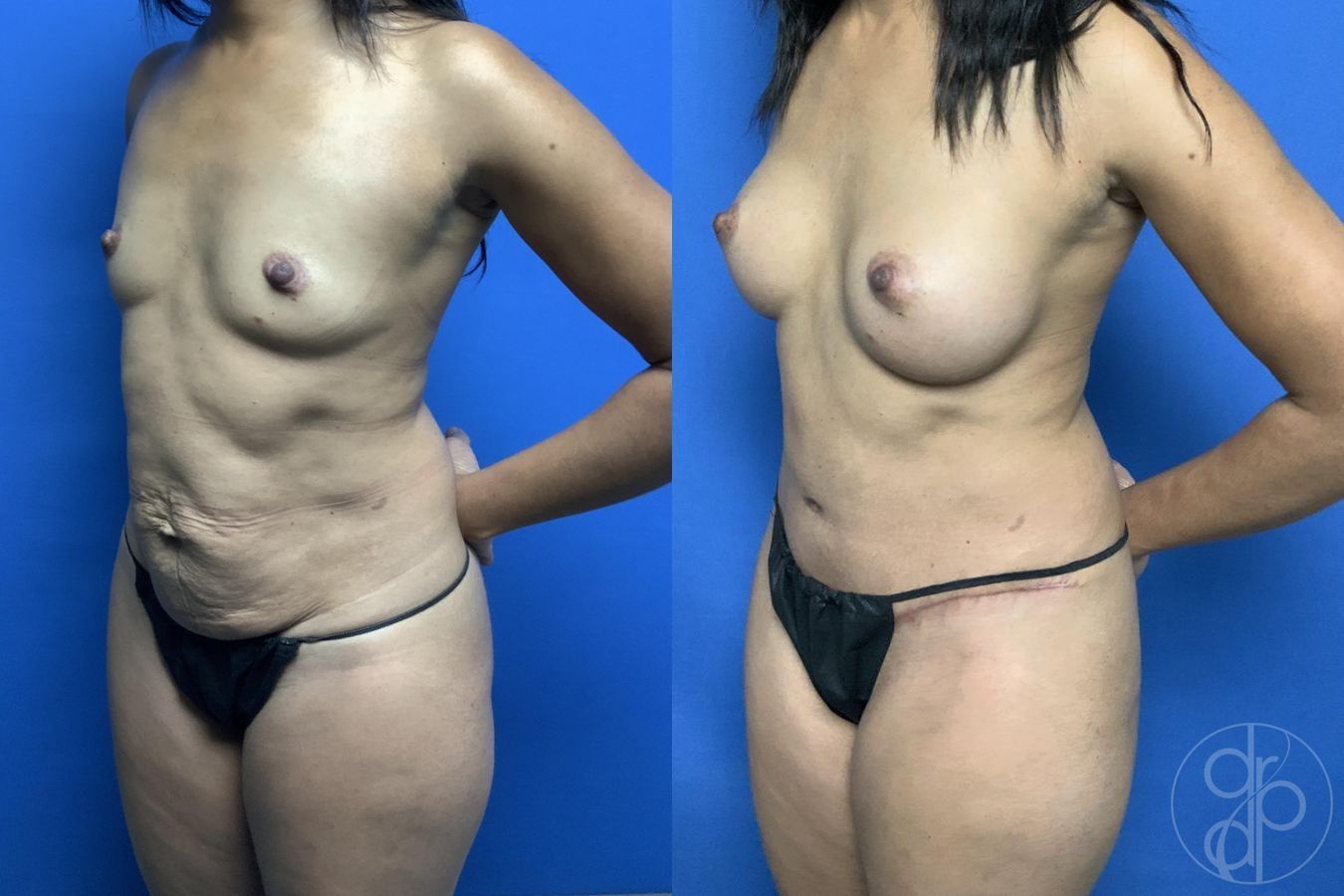 Before and after Mommy Makeover case 29732 - Angle 3