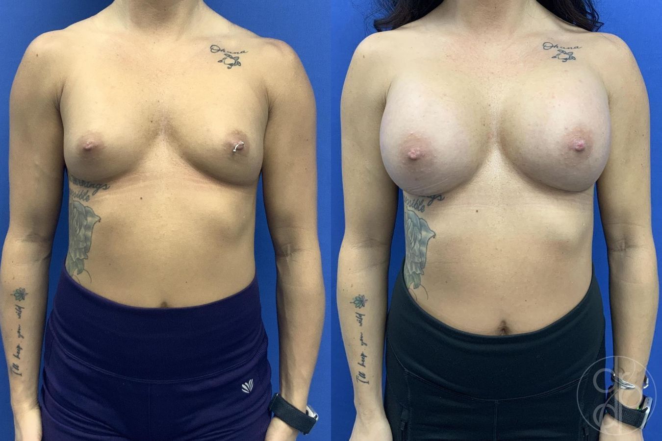 Before and after procedure result