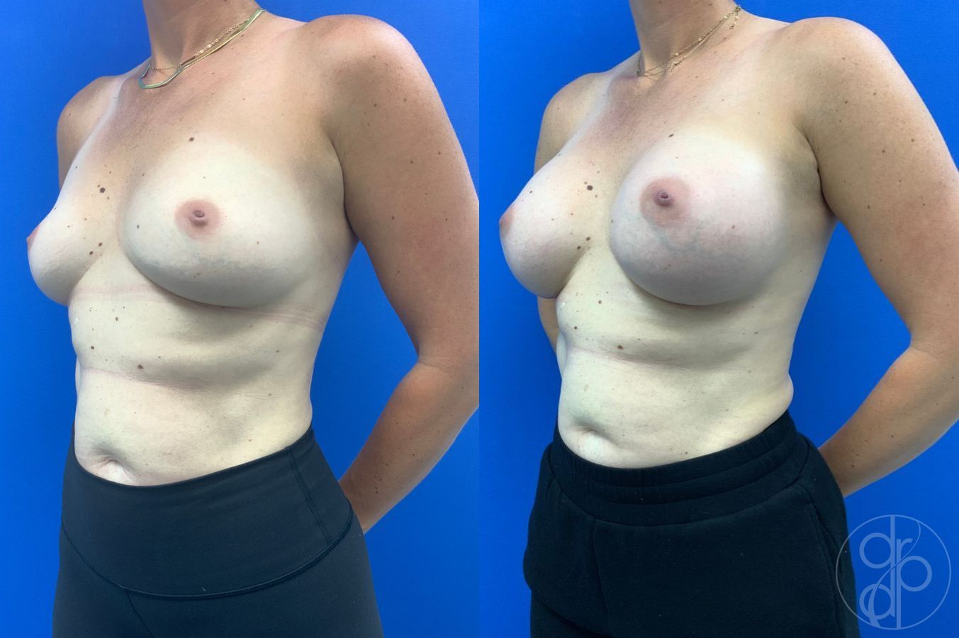 Before and after Breast Augmentation case 46263 - Angle 3