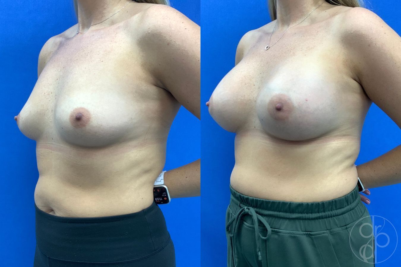 Before and after Breast Augmentation case 43197 - Angle 4