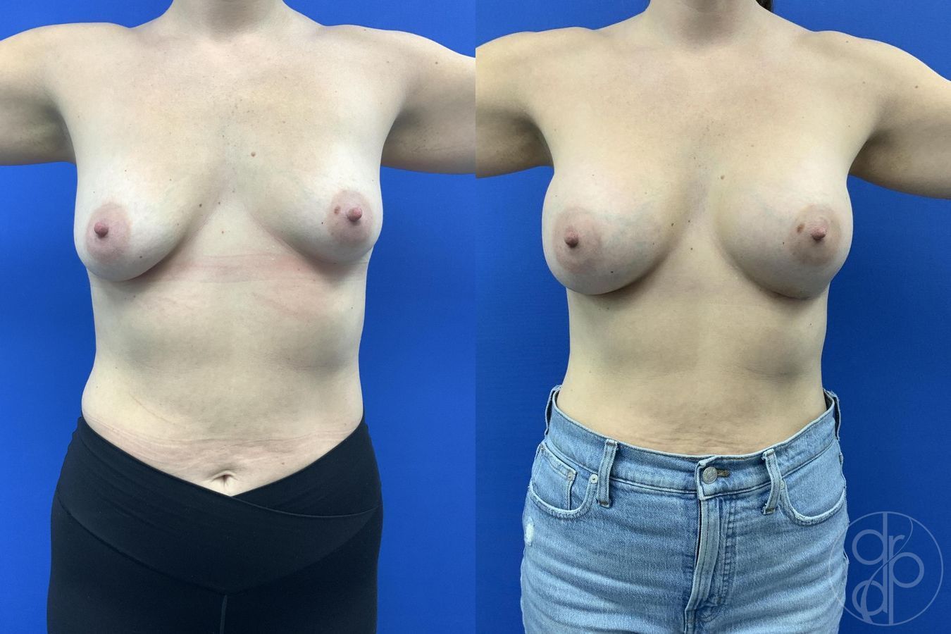 Before and after Breast Augmentation case 29655 - Angle 2