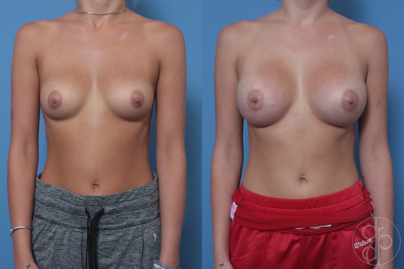 Before and after Breast Augmentation case 29939