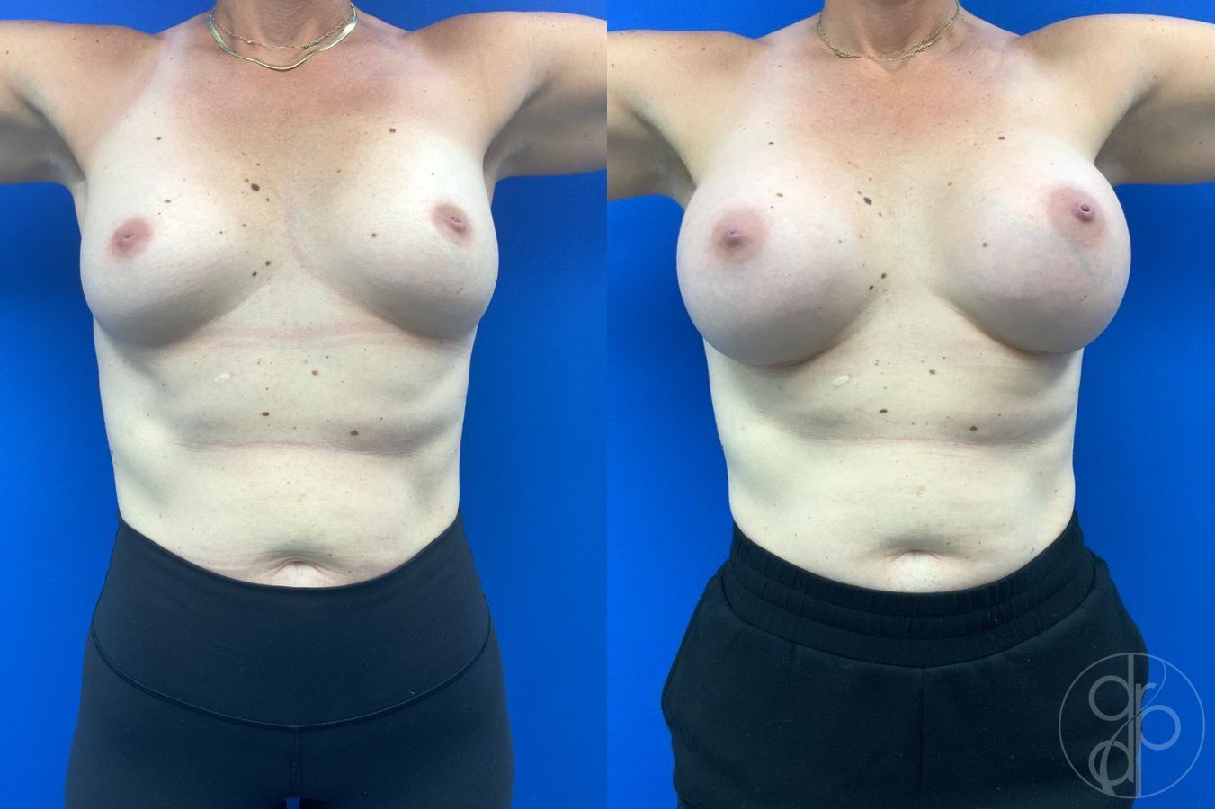 Before and after Breast Augmentation case 46263 - Angle 2