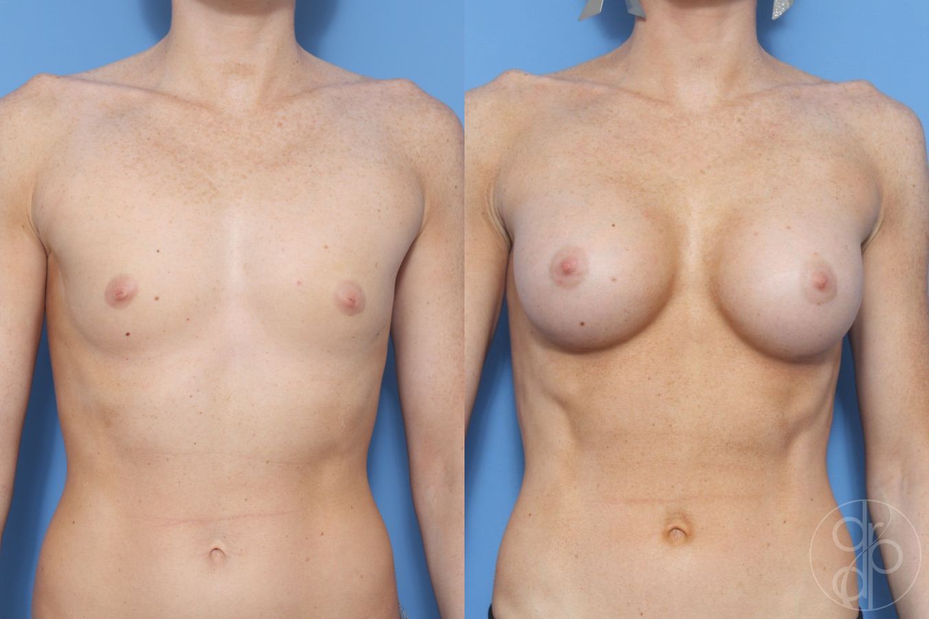 Before and after Breast Augmentation case 29958