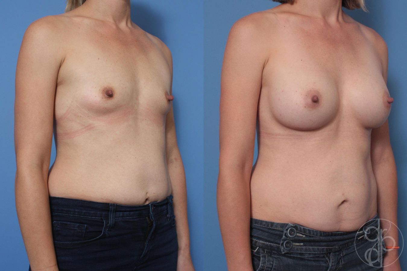 Before and after Breast Augmentation case 29644 - Angle 4