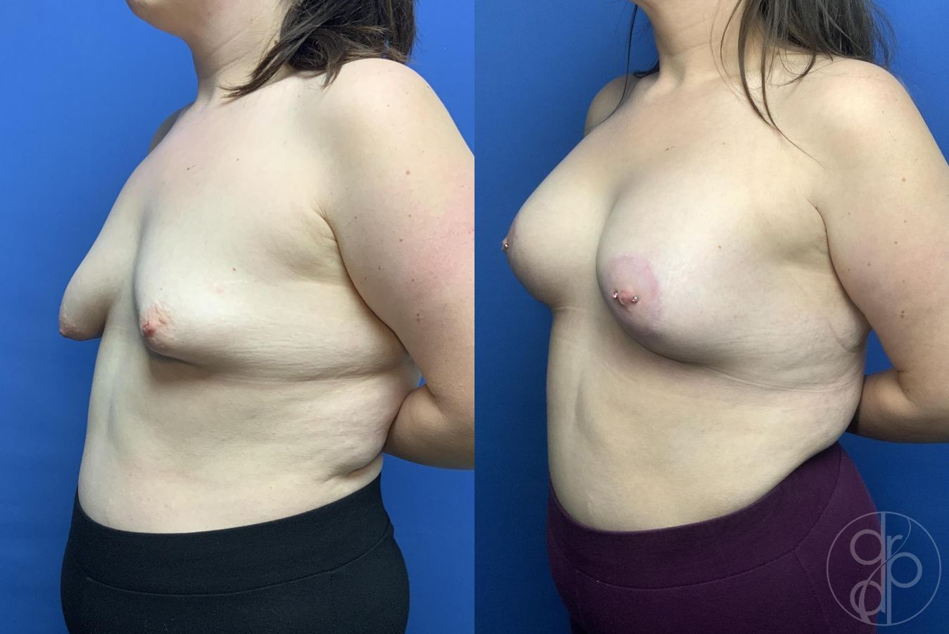 Before and after Breast Augmentation case 29979 - Angle 3