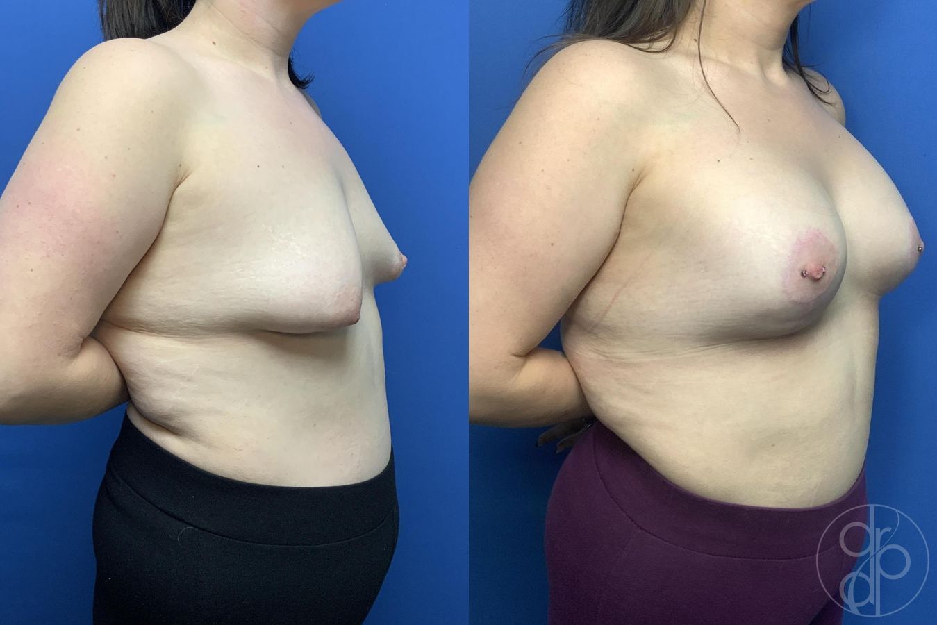 Before and after Breast Augmentation case 29979 - Angle 4