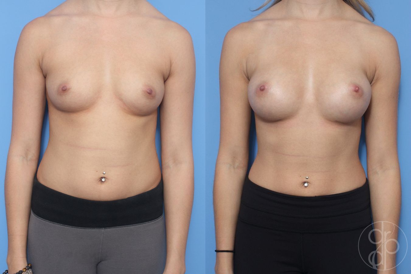 Before and after Breast Augmentation case 29908