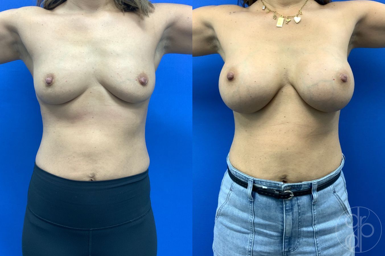 Before and after Breast Augmentation case 46261 - Angle 2