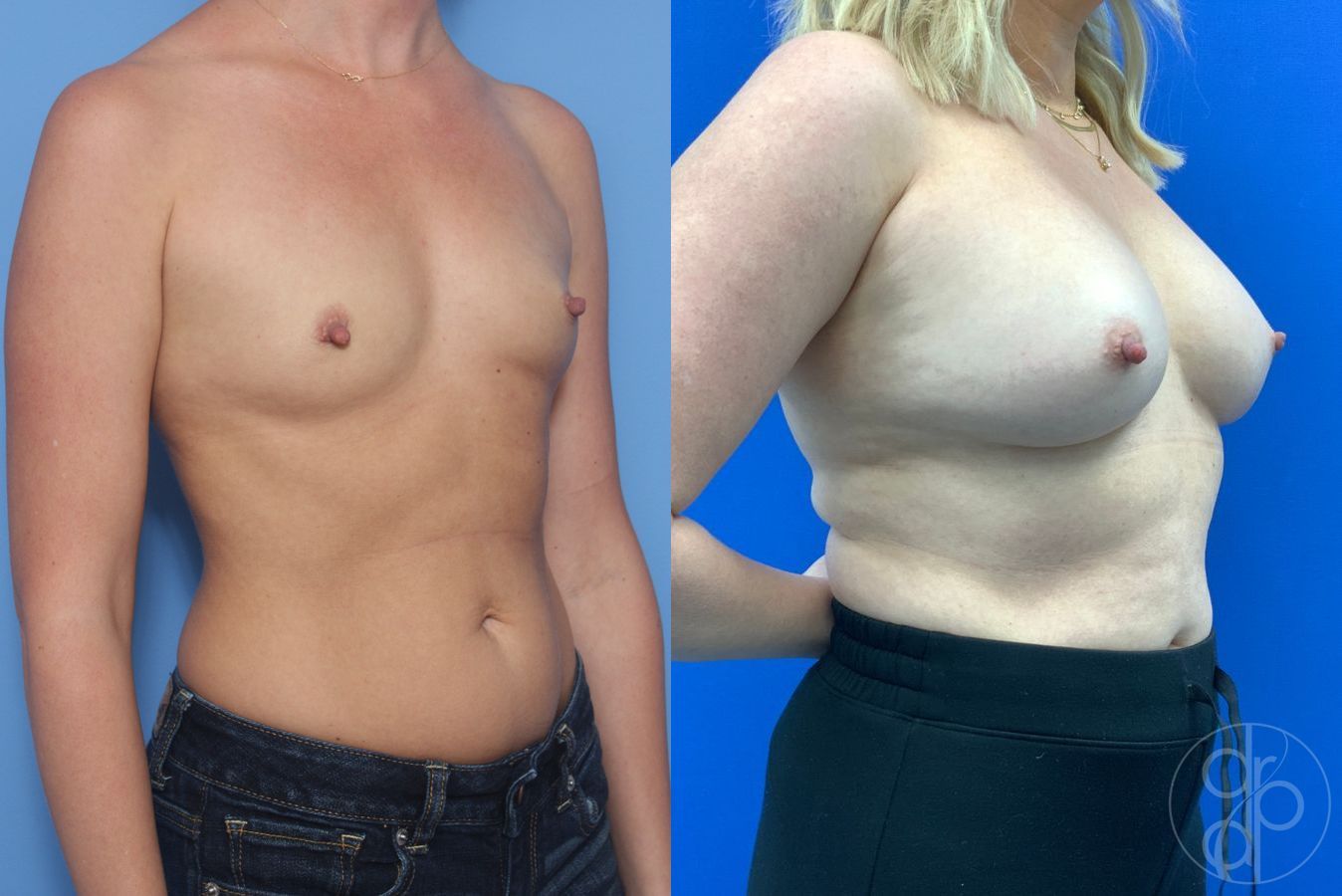 Before and after Breast Augmentation case 46257 - Angle 4