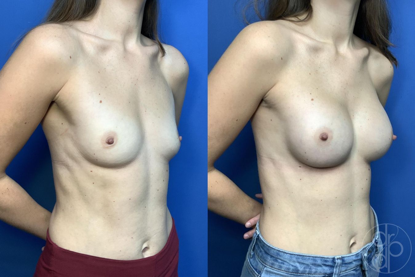 Before and after Breast Augmentation case 29991 - Angle 2