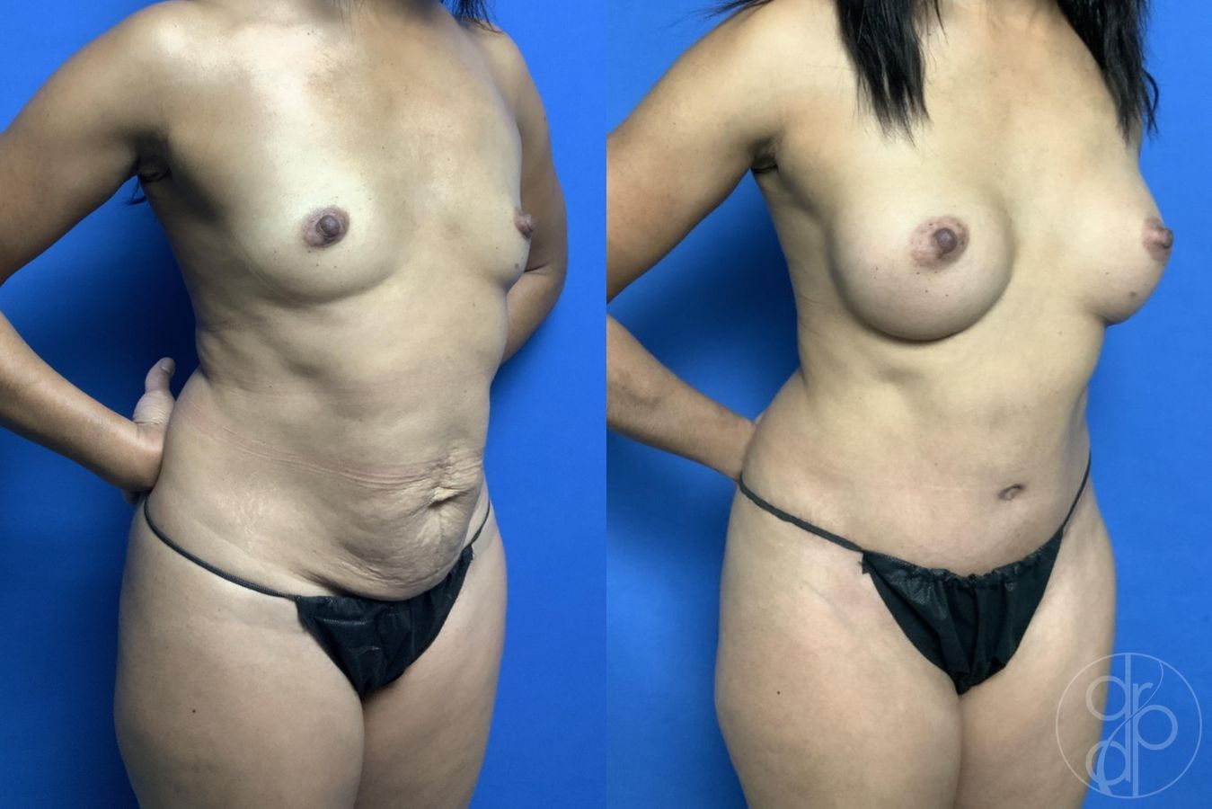 Before and after Mommy Makeover case 29732 - Angle 2