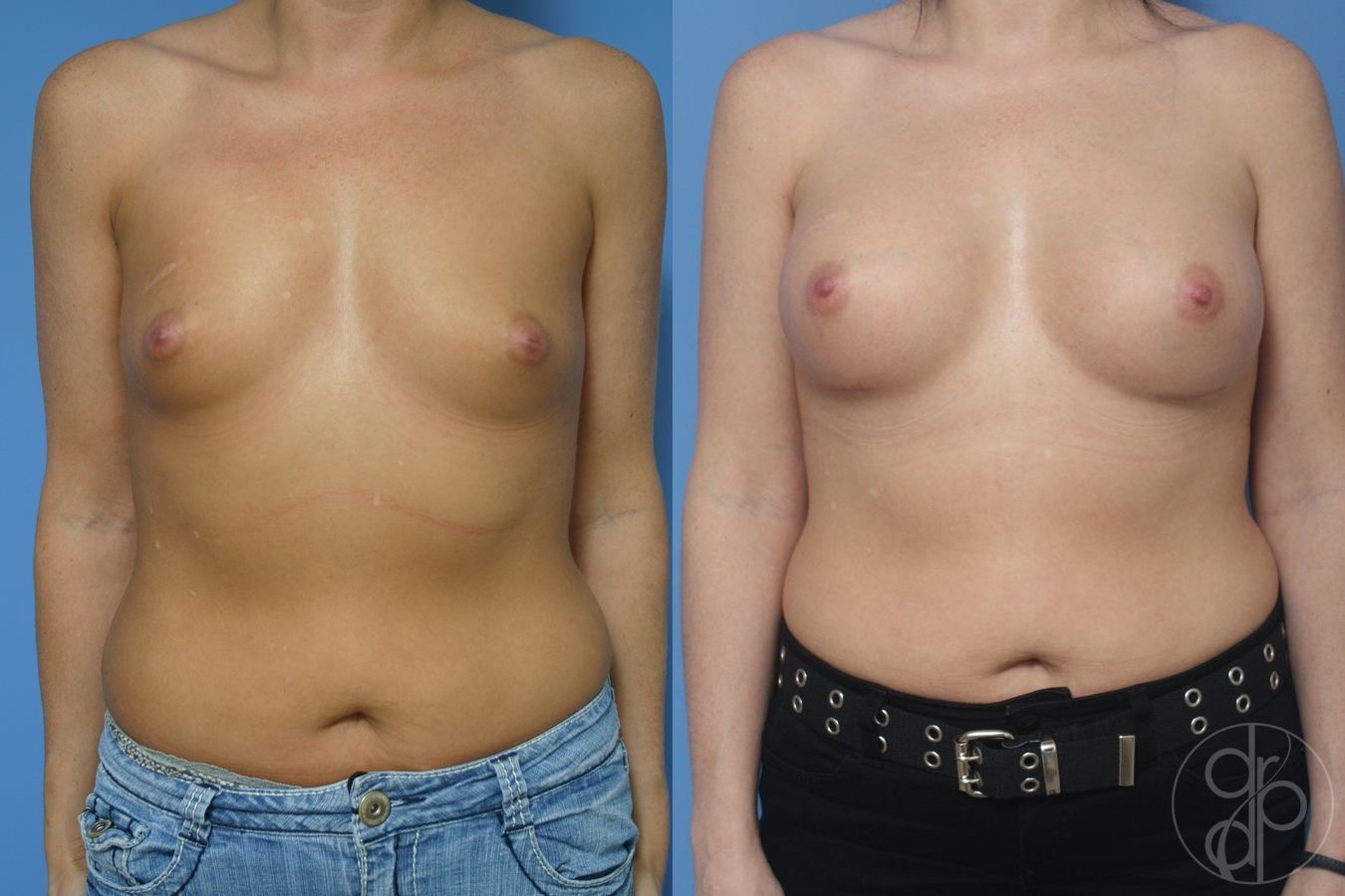 Before and after Breast Augmentation case 29915
