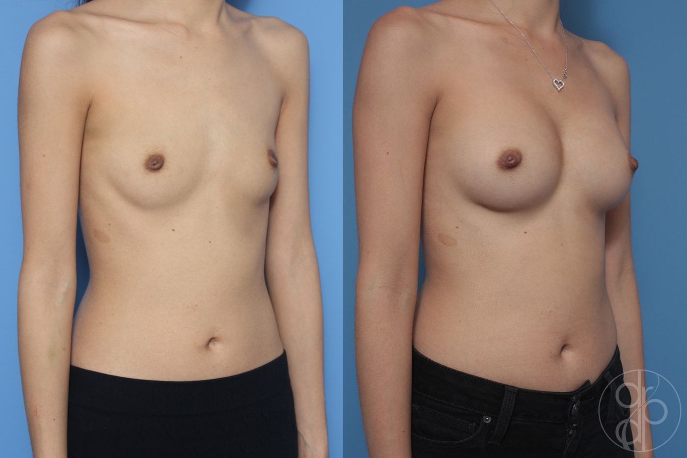 Before and after Breast Augmentation case 29833 - Angle 3