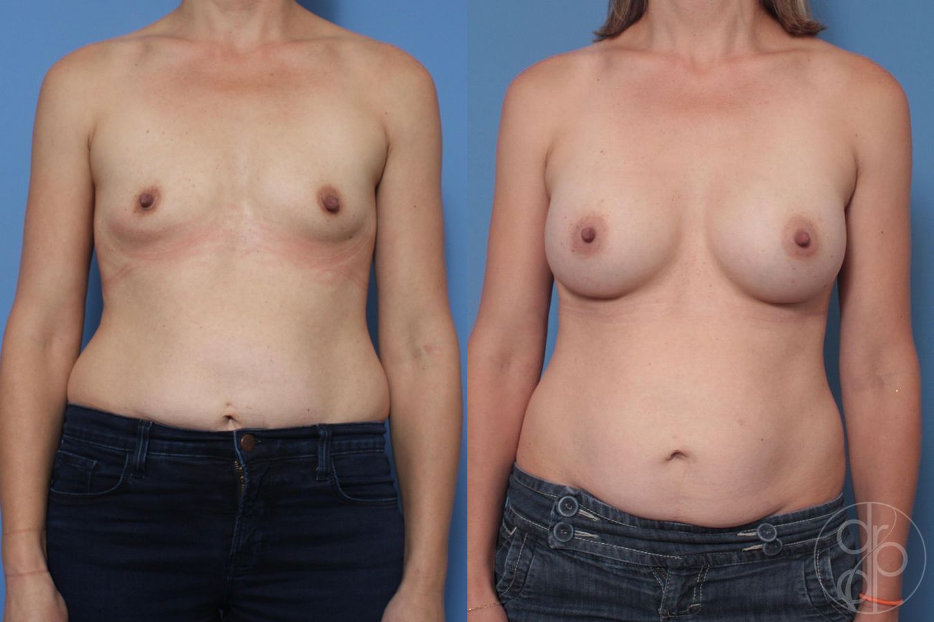 Before and after procedure result