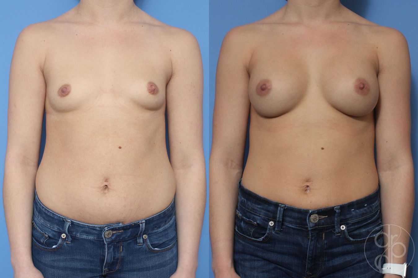 Breast Augmentation - Case 373