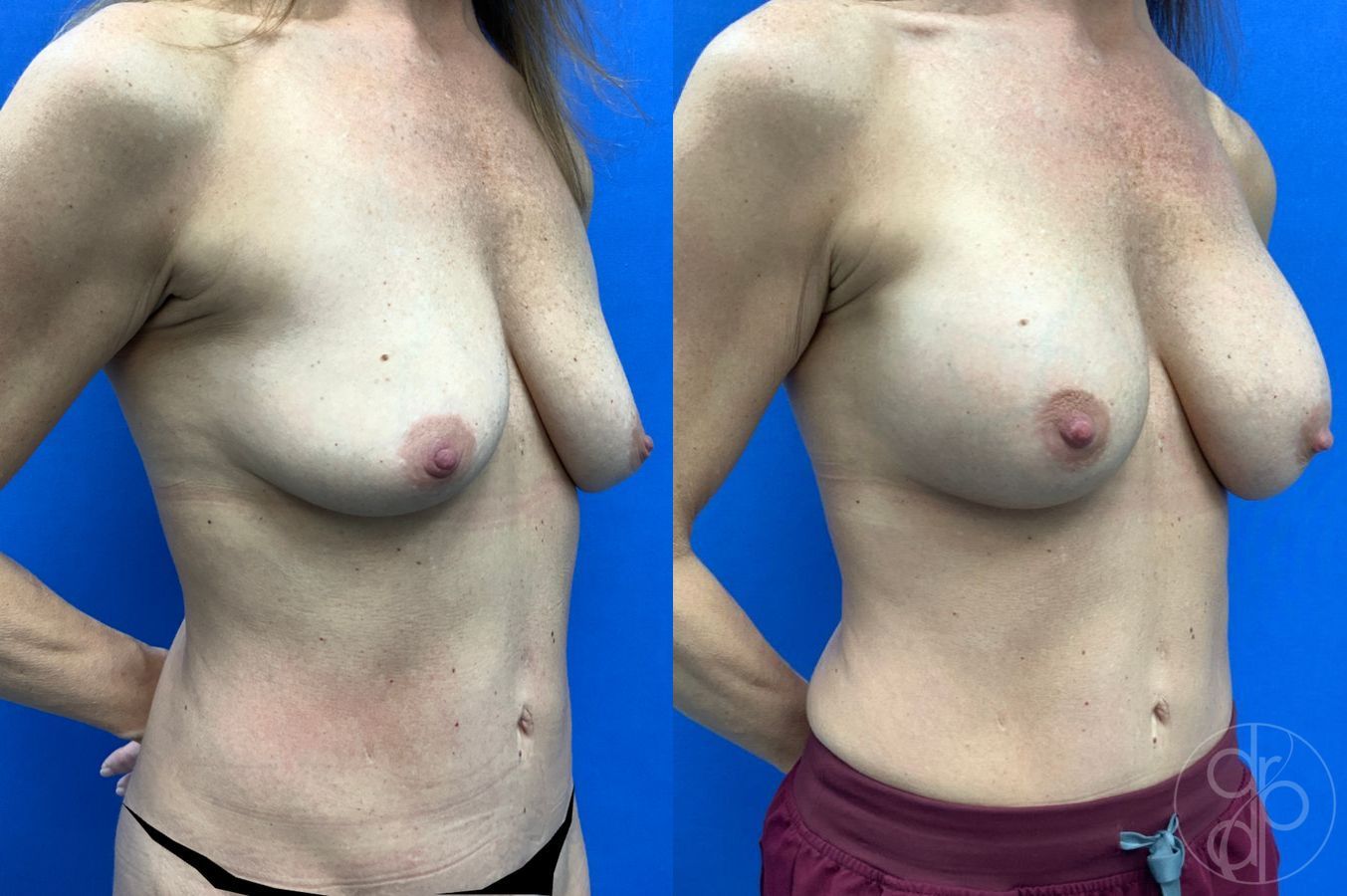 Before and after Breast Augmentation case 49416 - Angle 3