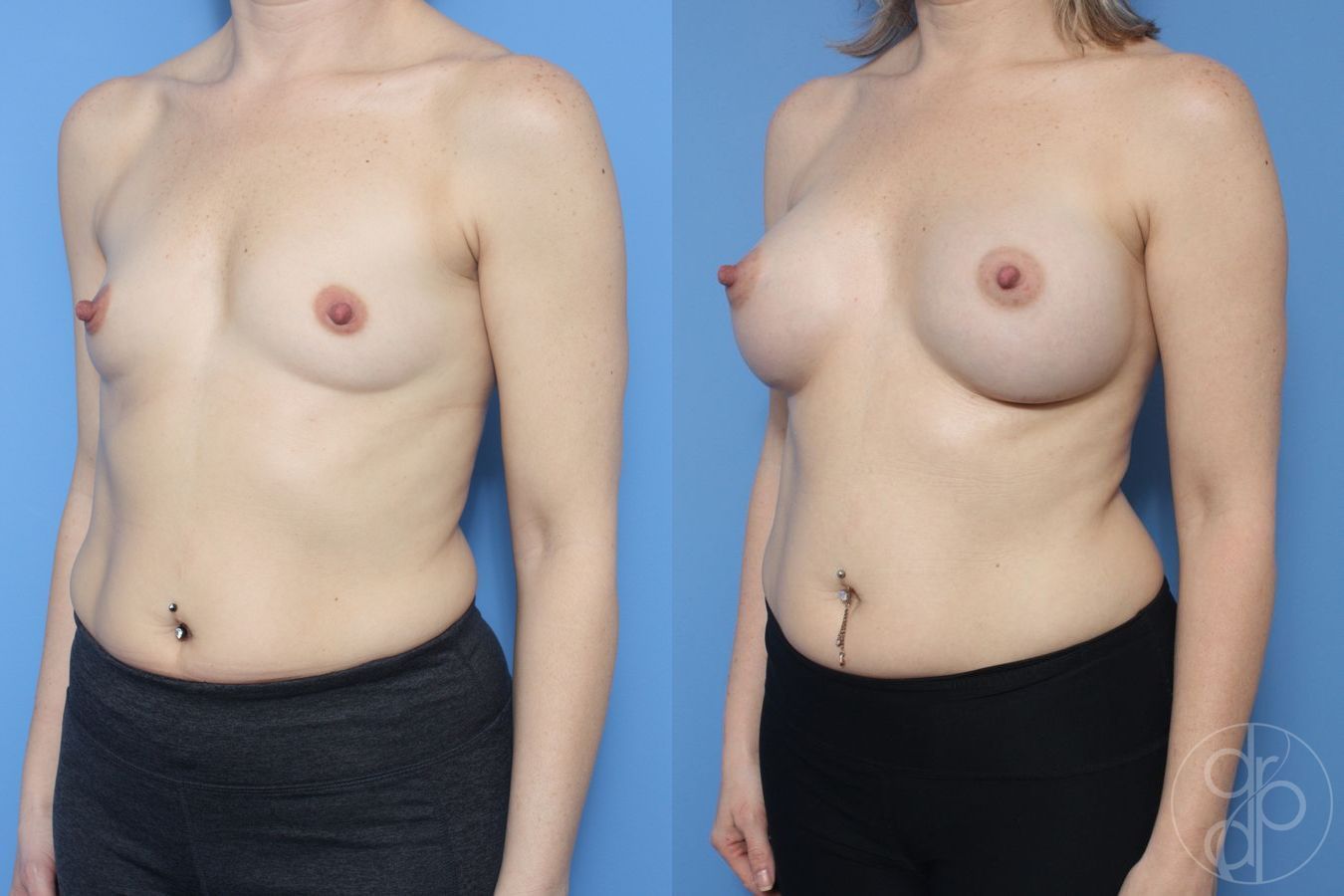 Before and after Breast Augmentation case 29927 - Angle 3