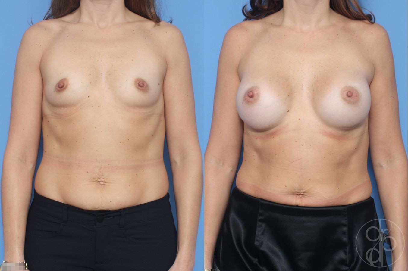 Before and after Breast Augmentation case 29928