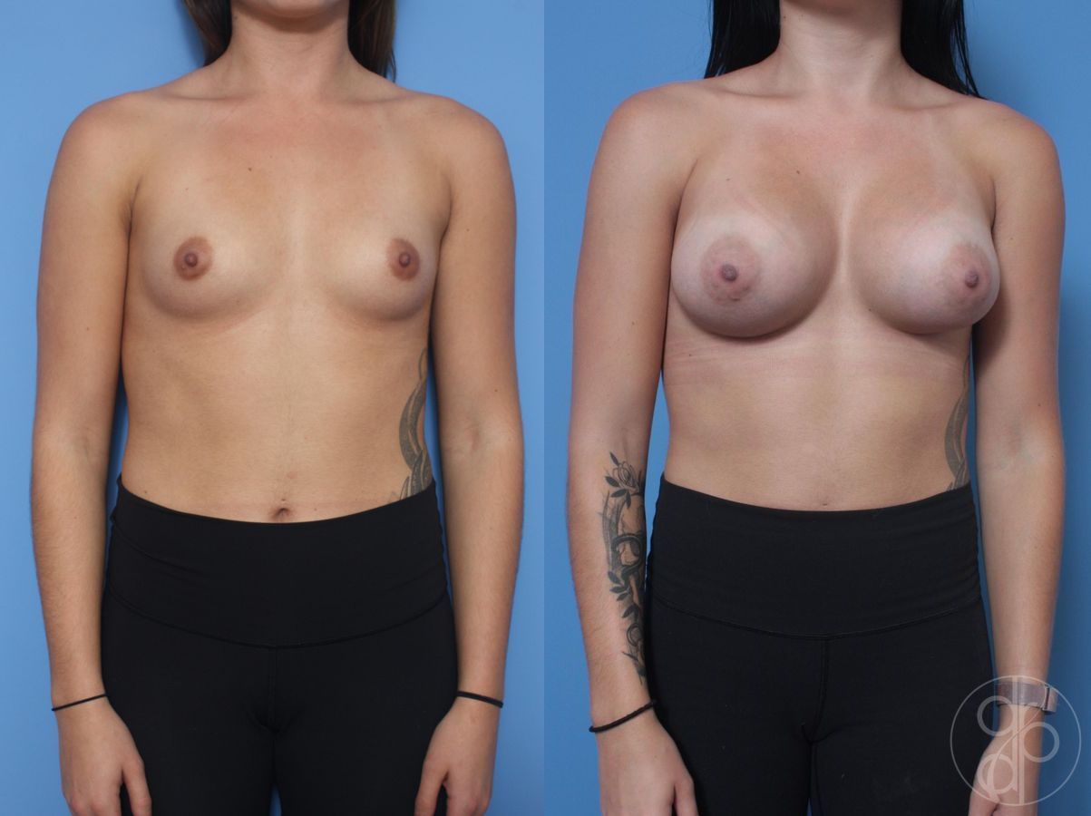 Before and after Breast Augmentation case 29819