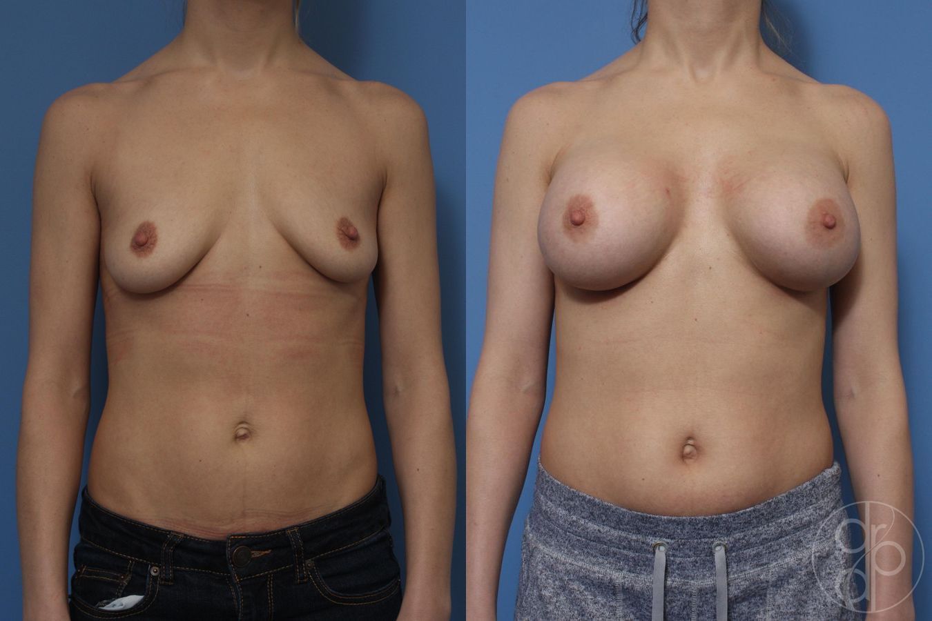 Breast Augmentation - Case 375