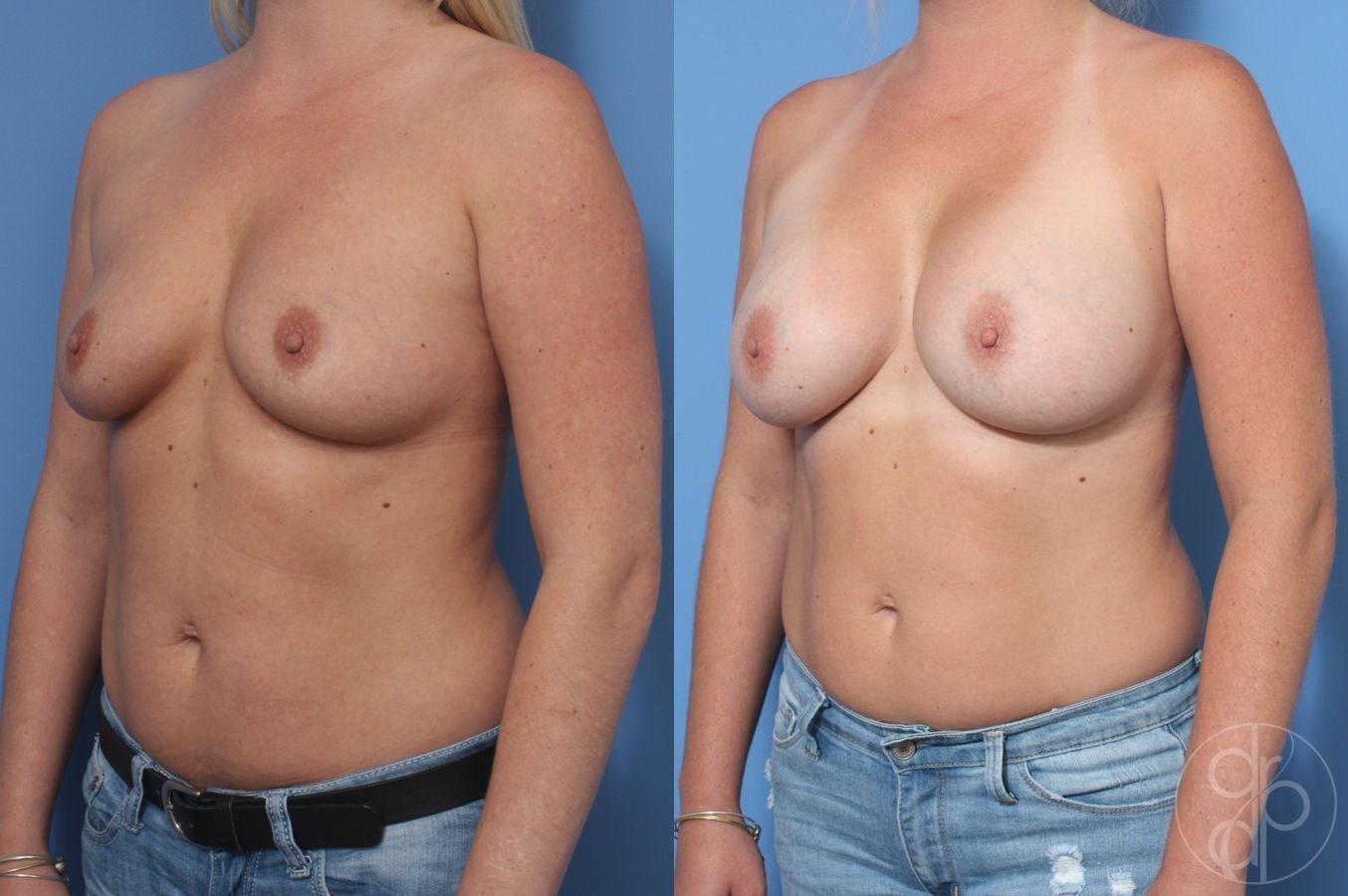 Before and after Breast Augmentation case 29957 - Angle 3