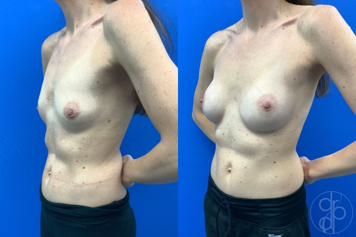 Before and after Breast Augmentation case 43474 - Angle 3