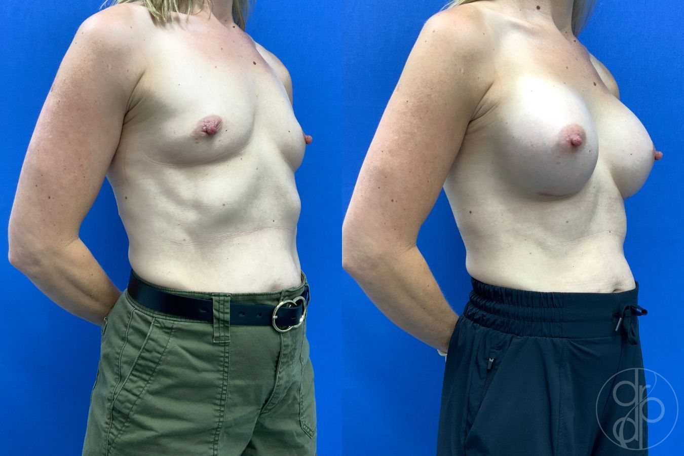 Before and after Breast Augmentation case 49410 - Angle 3