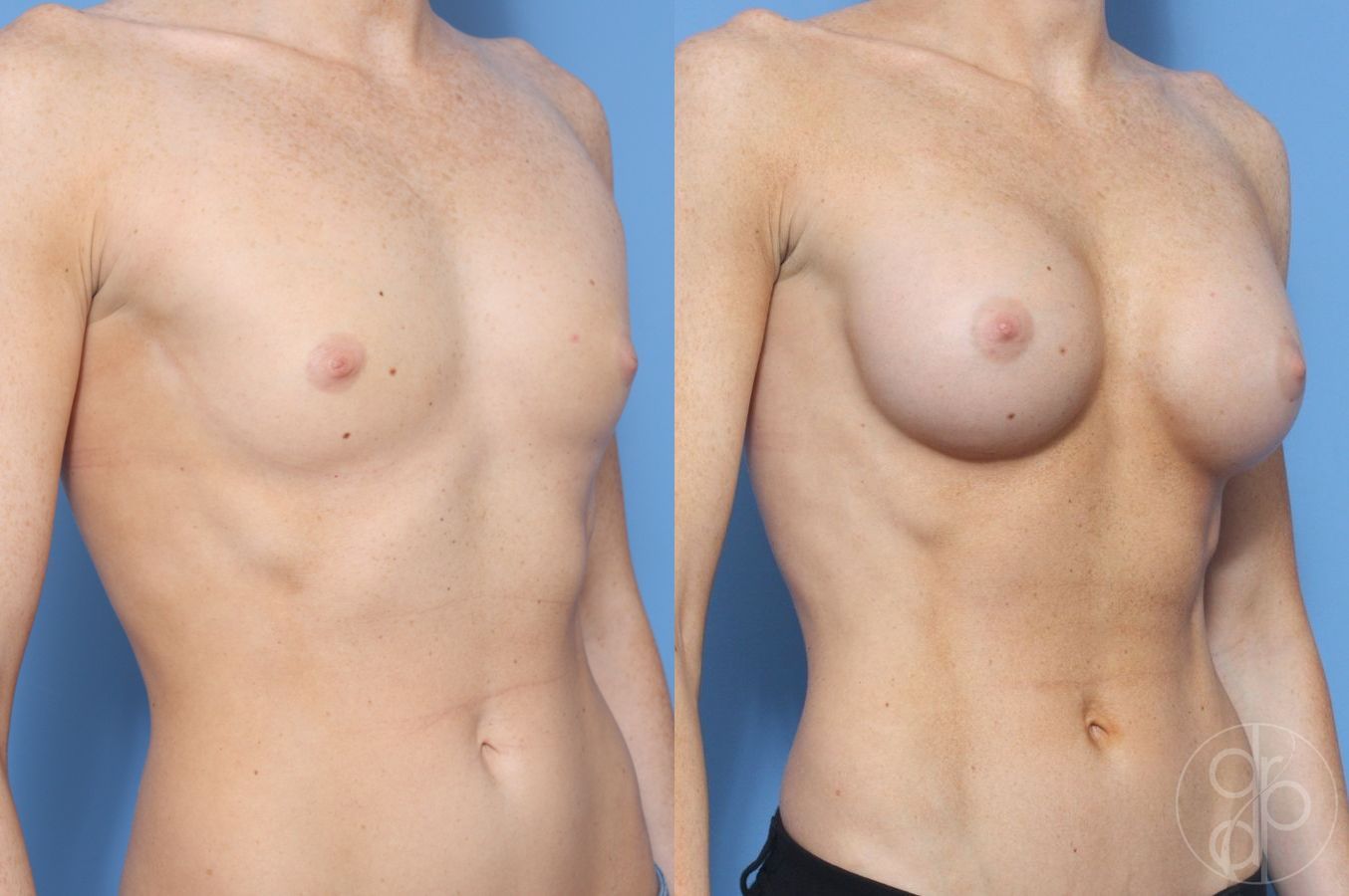 Before and after Breast Augmentation case 29958 - Angle 2